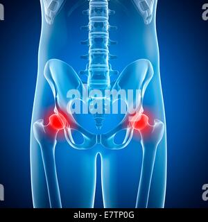 Schmerzhafte menschliche Hüftgelenke, Computer-Grafik. Stockfoto