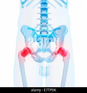 Schmerzhafte menschliche Hüftgelenke, Computer-Grafik. Stockfoto