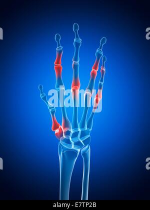 Menschliche Handgelenke Arthritis, Computer-Grafik zeigt. Stockfoto