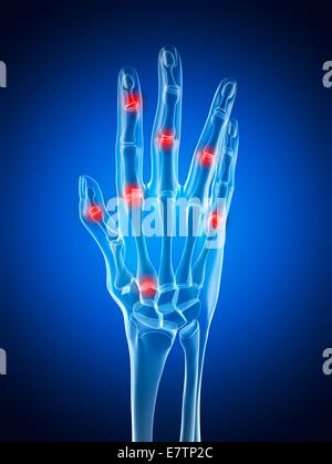 Menschliche Handgelenke Arthritis, Computer-Grafik zeigt. Stockfoto