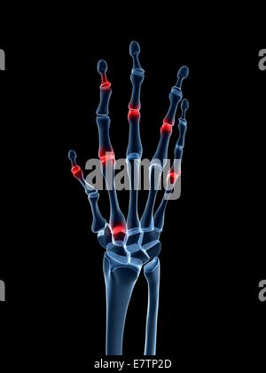 Menschliche Handgelenke Arthritis, Computer-Grafik zeigt. Stockfoto