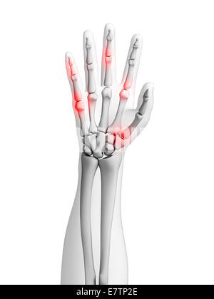 Menschliche Handgelenke Arthritis, Computer-Grafik zeigt. Stockfoto