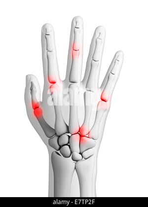 Menschliche Handgelenke Arthritis, Computer-Grafik zeigt. Stockfoto