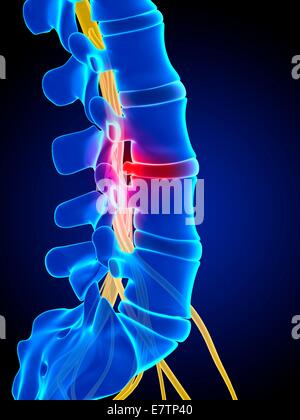 Menschliche Wirbelsäule Bandscheibenvorfall (Bandscheibenvorfall), Computer-Grafik. Stockfoto