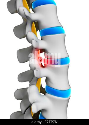 Menschliche Wirbelsäule Bandscheibenvorfall (Bandscheibenvorfall), Computer-Grafik. Stockfoto