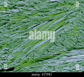 Farbige scanning Electron Schliffbild (SEM) von Harnsäure-Kristalle von der Zehe eines Patienten mit Gicht. Vergrößerte X 2000 auf 10 cm breit. Stockfoto