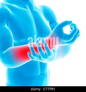 Menschlichen Arm-Schmerzen, Computer-Grafik. Stockfoto