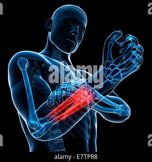 Menschlichen Arm-Schmerzen, Computer-Grafik. Stockfoto