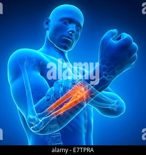 Menschlichen Arm-Schmerzen, Computer-Grafik. Stockfoto