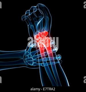 Menschlichen Handgelenk Schmerzen, Computer-Grafik. Stockfoto