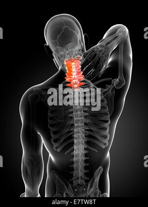 Menschlichen Nackenschmerzen, Computer-Grafik. Stockfoto