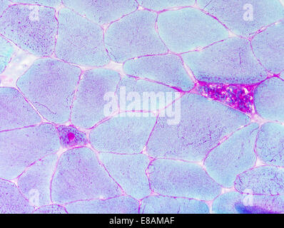 Morbus Pompe, Glycogeneinlagerung, Myopathie Stockfoto