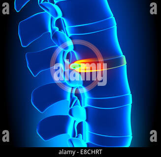 Bandscheibenvorfall-Bandscheibendegeneration - Wirbelsäulenproblem Stockfoto