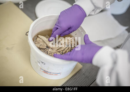 Menschliches Gehirn sezieren für medizinischen Test Demenz Stockfoto