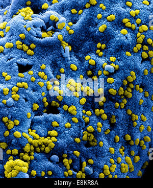 Eingefärbte scanning Electron Schliffbild der Middle Eastern respiratorische Syndrom Virus-Partikel an der Oberfläche befestigt ein Stockfoto