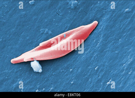 Dieser digital eingefärbt scanning Electron Schliffbild (SEM) offenbart einige der Ultrastrukturforschung Morphologie der Sichel-Zelle rot Stockfoto