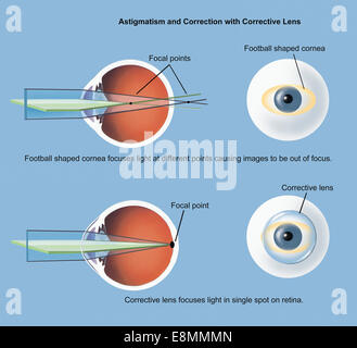 Astigmatismus und Korrektur mit Korrekturlinse. Stockfoto