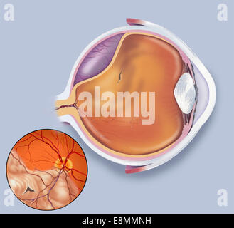Schematische Darstellung einer Netzhautablösung. Stockfoto
