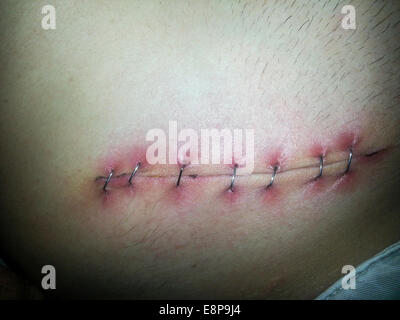 Metall-Fäden (Metall Staples). Ansicht des Metalls Heftklammern schließen eine chirurgische Wunde am Bauch eines Mannes. Stockfoto