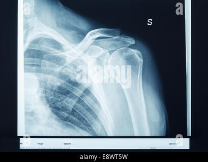 Röntgenbild Schulter Stockfoto
