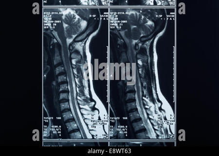 Röntgen Wirbelsäule und Nacken Stockfoto