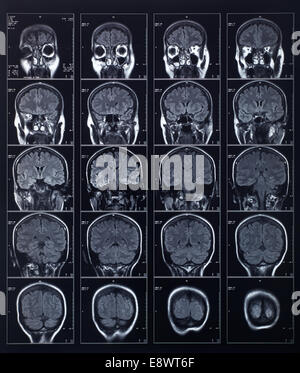 X-ray Kopf und Gehirn Stockfoto