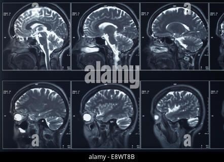 X-ray Kopf und Gehirn Stockfoto