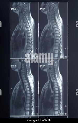 Röntgen Wirbelsäule und Nacken Stockfoto