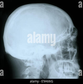 Röntgenbild eines menschlichen Schädels Stockfoto