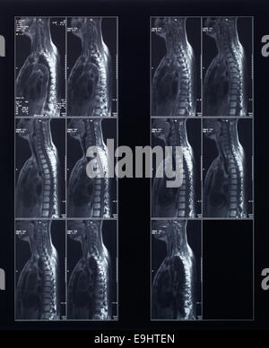 Wirbelsäule und Nacken Röntgen Röntgen Stockfoto