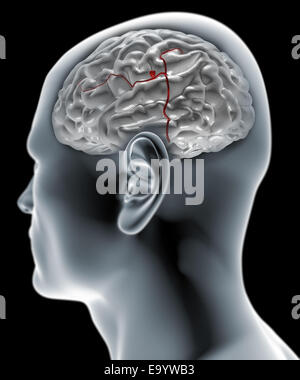 Den Kopf im Profil, das Röntgenbild mit Hirn-Aneurysma Stockfoto