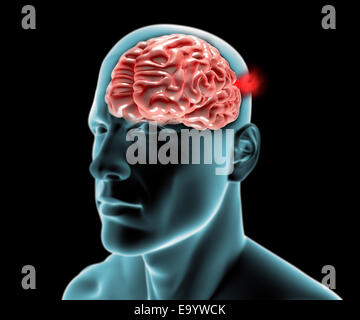 Den Kopf im Profil, das Röntgenbild mit Hirn-Aneurysma Stockfoto