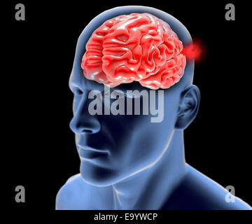 Den Kopf im Profil, das Röntgenbild mit Hirn-Aneurysma Stockfoto