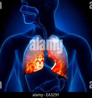 Lungenentzündung - entzündliche Erkrankung der Lunge Stockfoto