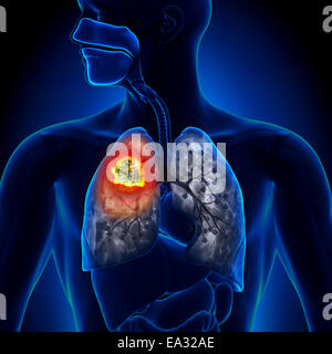 Lungenkrebs - Tumor-detail Stockfoto