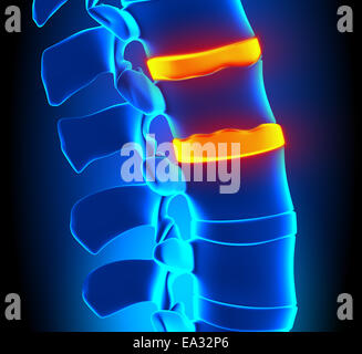 Osteophyt Bildung Bandscheibendegeneration - Wirbelsäulenproblem Stockfoto