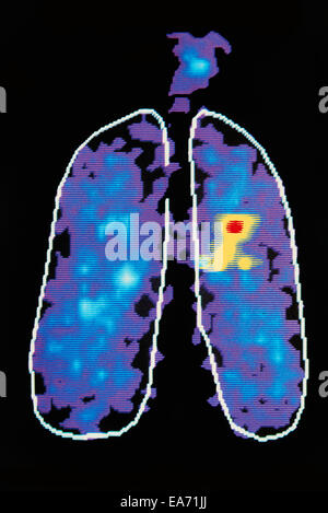 Grafische Darstellung Diesease In der menschlichen Lunge Stockfoto