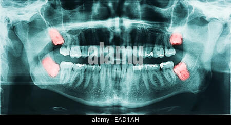 Wachsende Weisheitszähne Schmerzen auf Röntgenbild Stockfoto