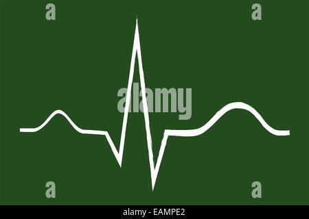 Normale Elektrokardiogramm Grafik erklärt auf Tafel Stockfoto