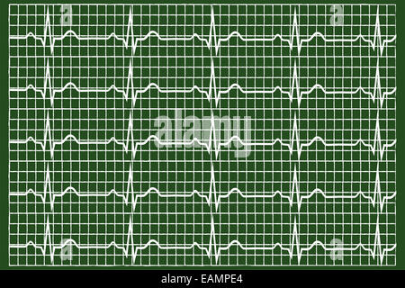 Normale Elektrokardiogramm Grafik erklärt auf Tafel Stockfoto