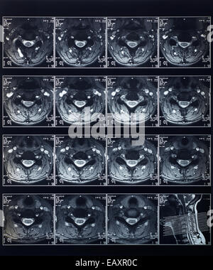 Röntgen Wirbelsäule Röntgen Stockfoto