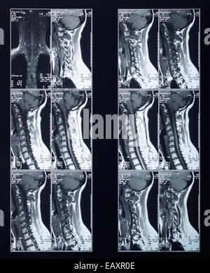 Wirbelsäule und Nacken Röntgen Röntgen Stockfoto