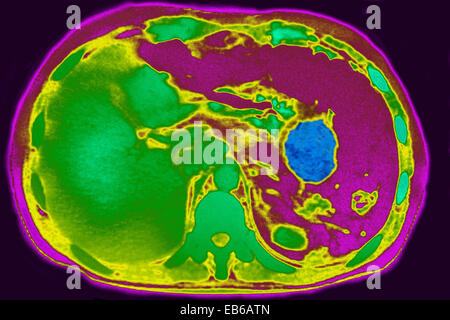 PANKREAS ZYSTE, CT-SCAN Stockfoto