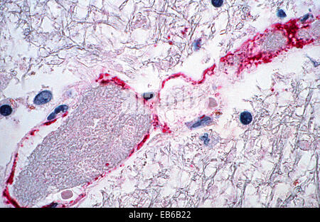 NIPAH-VIRUS-INFEKTION Stockfoto