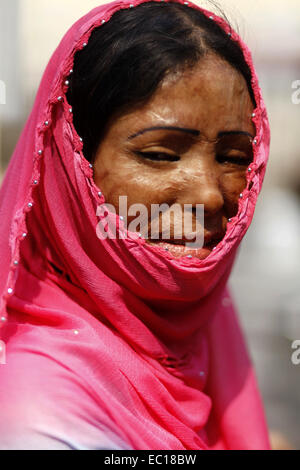 Dhaka, Bangladesch. 7. März 2014. 7. März 2014 - Dhaka, Bangladesch - Dhaka, Bangladesch, 7. März 2014:. Überlebenden der Säureattacken, besuchen eine Menschenkette gegen sauren Gewalt am Vorabend der Feier der Internationale Frauentag in Dhaka, Bangladesch zu protestieren. Je nach Säure Überlebenden Foundation (ASF) gab 3.184 Säureattacken seit Februar 1999 bis Februar 2014 in Bangladesch, wo 1.792 Frauen Opfer unter insgesamt 3.512 waren. Säureattacken sind meist üblich, in Kambodscha, Pakistan, Afghanistan, Indien, Bangladesch und im nahen Ausland. Es wird geschätzt, dass einige 80 Perce Stockfoto