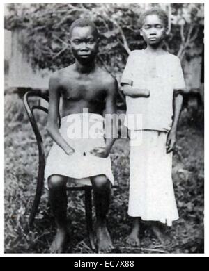 Amputation wurde häufig verwendet, um Arbeiter in den Kongo-Freistaat zu bestrafen;   gesteuert durch Leopold II von Belgien 1900 Stockfoto