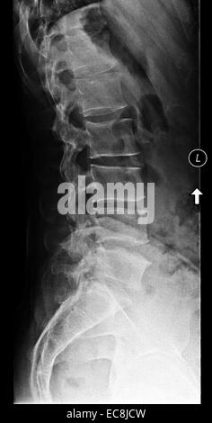 x-ray zeigt degenerative Bandscheibenerkrankungen Lendenwirbel L5-6, Seitenansicht, 40 Jahre alt, Männlich, Thema hat eine extra Lendenwirbel Stockfoto