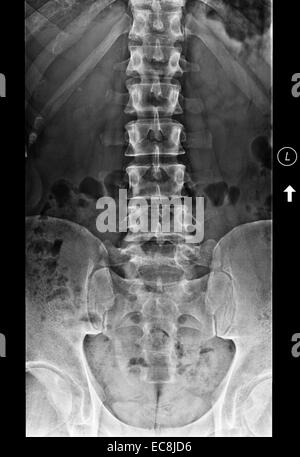 x-ray zeigt degenerative Bandscheibenerkrankungen Lendenwirbel L5-6, medialen Blick, 40 Jahre alt, Männlich, Thema hat eine extra Lendenwirbel Stockfoto