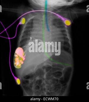 Röntgen-Thorax des Kindes zeigt einen Herzschrittmacher und kardiale Monitor führt. Stockfoto