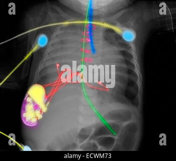 Röntgen-Thorax des Kindes zeigt einen Herzschrittmacher und kardiale Monitor führt. Stockfoto